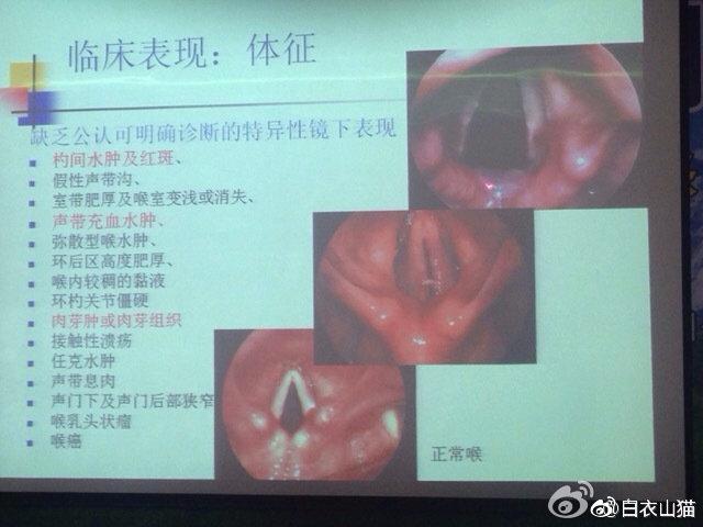 她夜间咳嗽，白天咽痛声音嘶哑，我为什么要她吃胃药？