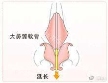 工匠的技术-3【鼻中隔延长术】