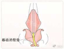 工匠的技术-3【鼻中隔延长术】