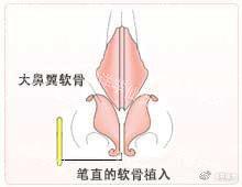 工匠的技术-3【鼻中隔延长术】