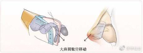 工匠的技术-3【鼻中隔延长术】