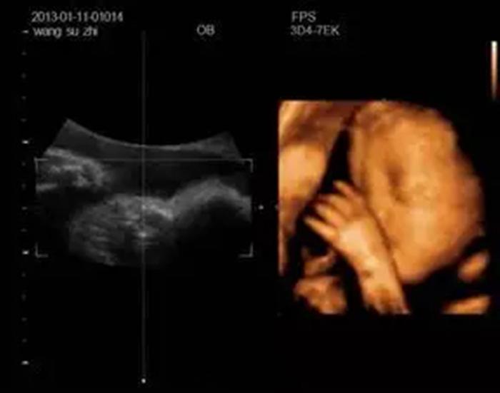 孕检时，胎儿表情究竟多可爱！比剪刀手、竖大拇指、打哈欠……