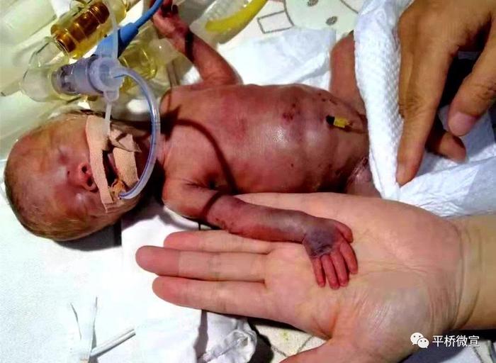 出生时仅800克的“袖珍婴儿”出院了，这个过程好暖心！