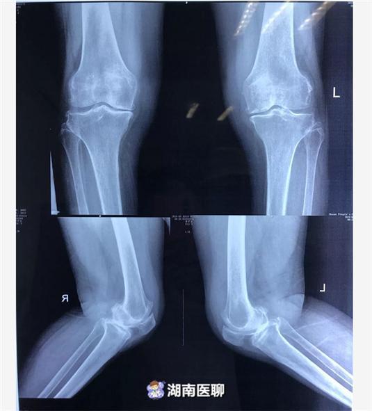 老太关节炎多年痛难当！“硬扎”关节置换，手术台上踢腿？