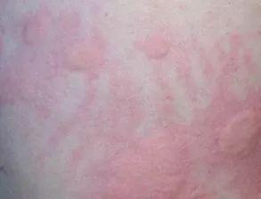 荨麻疹“寻事生非”不要怕豫东医院皮肤科专家带您正确认识荨麻疹
