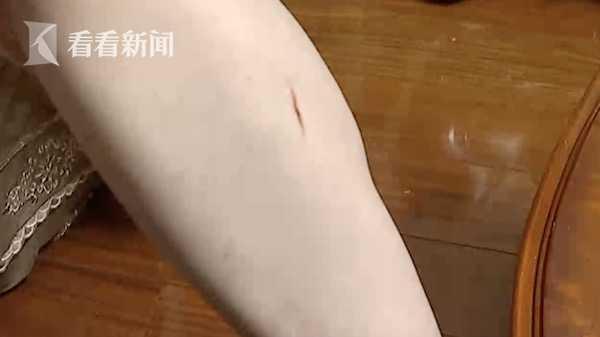 嘭！淋浴房突然炸裂 女子澡没洗成全身被划伤