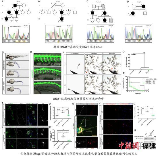 闽学者发现遗传性痉挛性截瘫新亚型及新致病基因