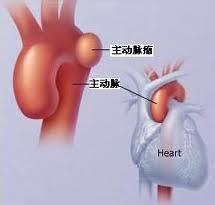 加拿大科学家发现“血管胰岛素”，保护人们免受心血管疾病危害