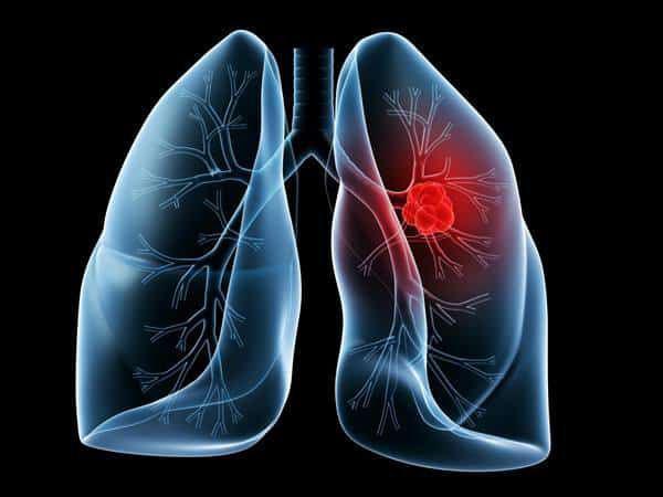 肺癌出现胸腔积液，除了放化疗，还能怎么办？