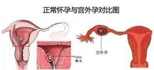 陈慧琳、张柏芝也曾出现这种状况，导致流产，孕早期的妈妈要注意