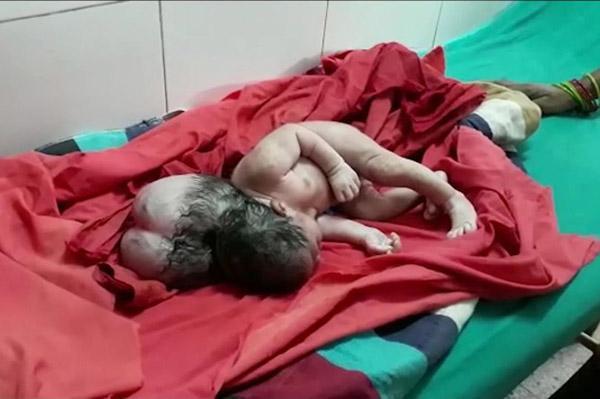 罕见！印度产妇生下畸形“三头女婴”