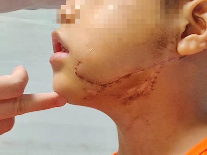 南宁8岁男孩面部撕裂后续：手术历时7小时，缝了几十针…