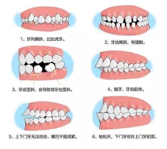 牙齿畸形及时矫正，妈妈再也不用担心我长“小龅牙”啦