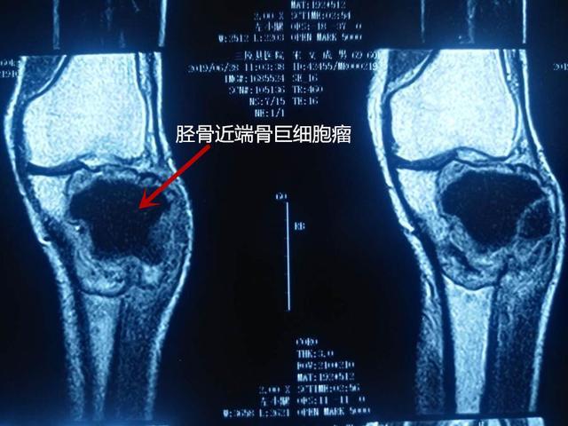 老人患骨肿瘤临截肢风险  3D打印定制假体助力行走