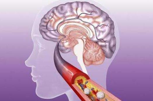 预防脑梗，改变饮食很重要！专家建议：多吃3种食物预防脑梗塞