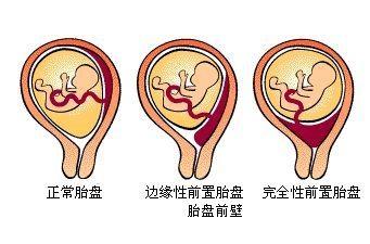 胎盘前壁≠胎盘前置，两者区别很大，孕期风险要提前了解