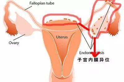 痛经不孕，原来是子宫内膜异位症在“搞事情”！