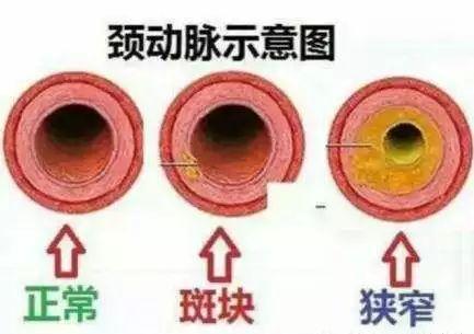 体检查出颈动脉斑块别慌