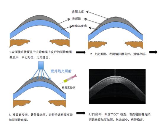 沉默的“视力杀手”圆锥角膜病有了新疗法