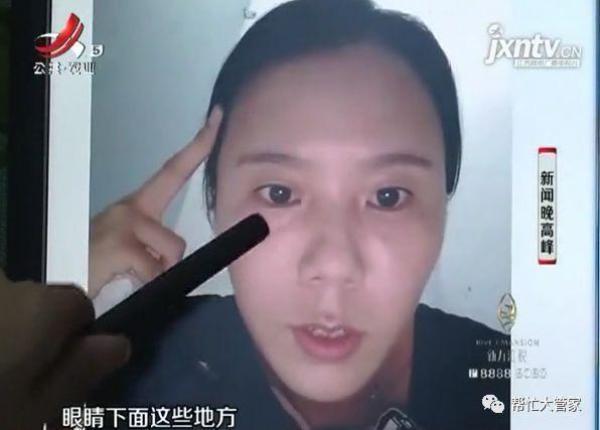 女子在萍乡丽芙医疗美容诊所注射玻尿酸 脸变形了