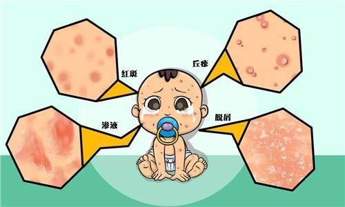 奶藓、痱子、荨麻疹、婴儿痤疮.....宝宝这些皮肤病你会处理吗？