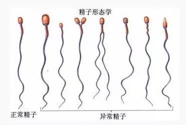 99%精子畸形率，影响做试管婴儿吗？