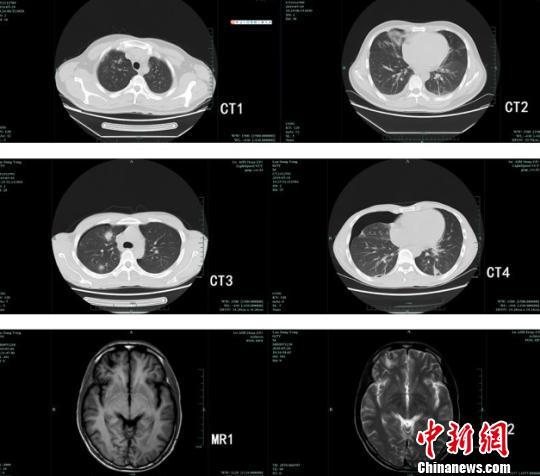 四小伙吃生蟹患肺吸虫病 专家：需改变生食习惯