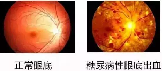世界爱眼日 | 全球超22亿人视力受损，高度近视成致盲主因