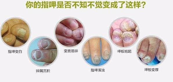 灰指甲怎么得的？医生提醒：3种治疗，一种最有效，保障指甲靓丽