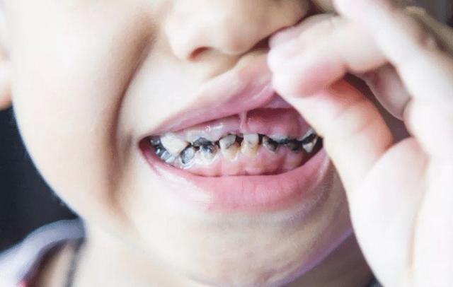 牙科医生提醒，孩子正在换牙的父母们，你们一直都做错了什么？