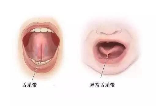 思量再三还是带宝宝去剪舌系带，医生那一剪刀看得我心好疼