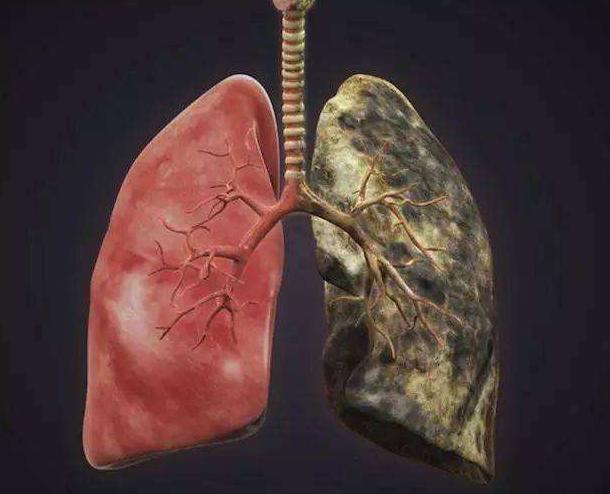 肺癌不是悄无声息，手指出现3种“异常”，最好查一下肺部CT