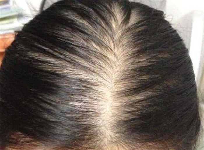 头发扣下来的“白泥”是什么？又臭又痒，难怪脱发都要“掉光”了