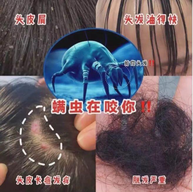 头发扣下来的“白泥”是什么？又臭又痒，难怪脱发都要“掉光”了