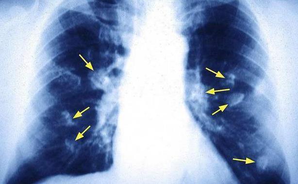 肺部受损时，身体会出现这3个表现，还请检查一次肺部！