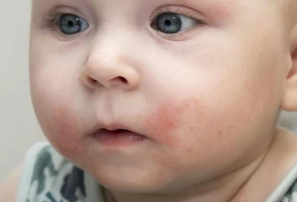 冬季儿童湿疹高发，带娃4招来预防，坚持1周，摆脱干痒湿疹