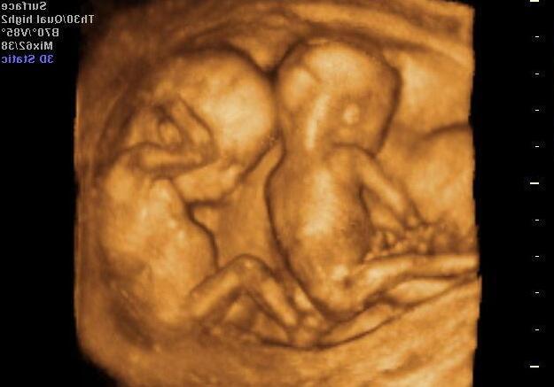 胎儿“太害羞”，做四维总是不露脸，孕妇很着急，医生却说没关系