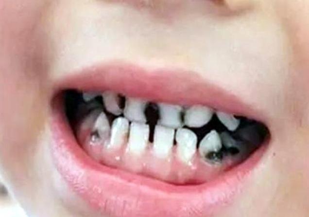 4岁女童满口“黑牙”，奶奶带孩子去看牙医，医生：不是糖的锅