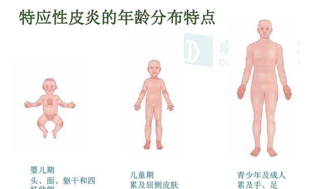 宝宝得了湿疹，宝爸宝妈该如何护理最有效？