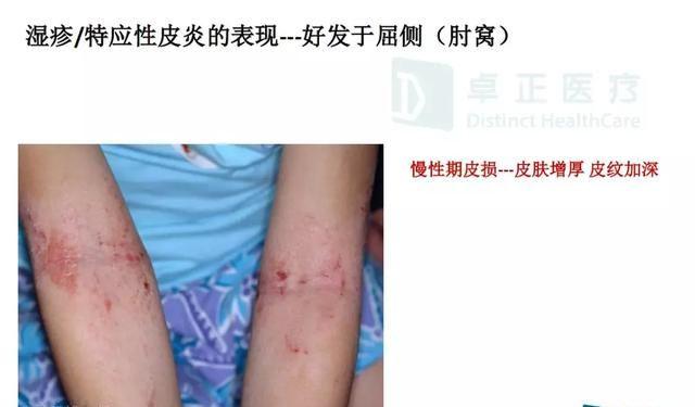 宝宝得了湿疹，宝爸宝妈该如何护理最有效？