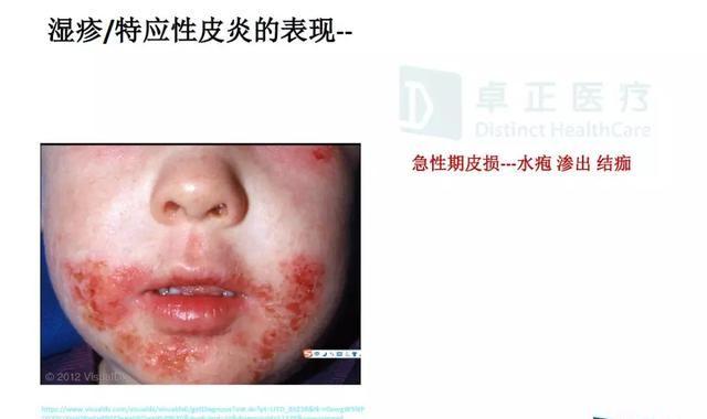 宝宝得了湿疹，宝爸宝妈该如何护理最有效？