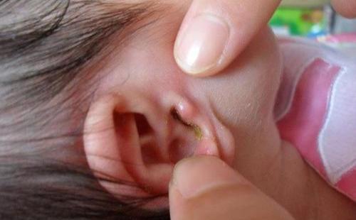 孩子感冒为何容易引发中耳炎？竟然与宝宝擦鼻涕的方法密切相关