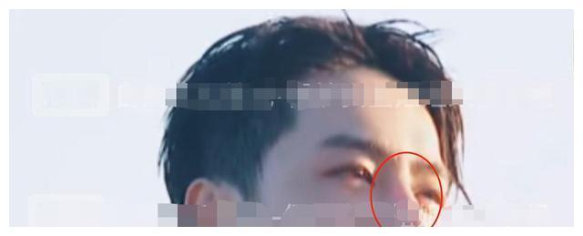 打架鼻梁骨折赔偿标准 鼻梁骨折算轻伤吗