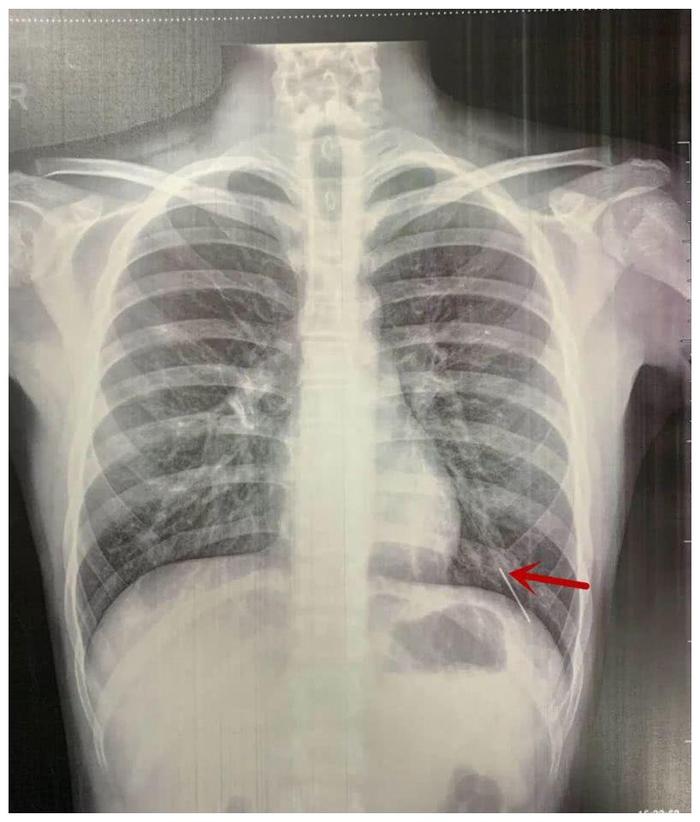 惊险！长沙13岁男孩上网课太入神，7厘米针灸针被误吞扎进肺里