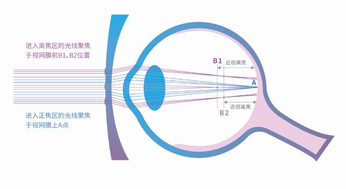 近视增长减缓50％，近视性视网膜病变风险将降低10倍！