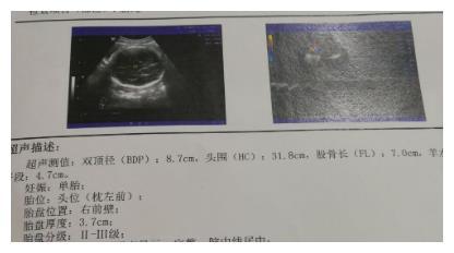 孕期不同阶段B超单信息，关乎胎儿健康，你都知道吗？