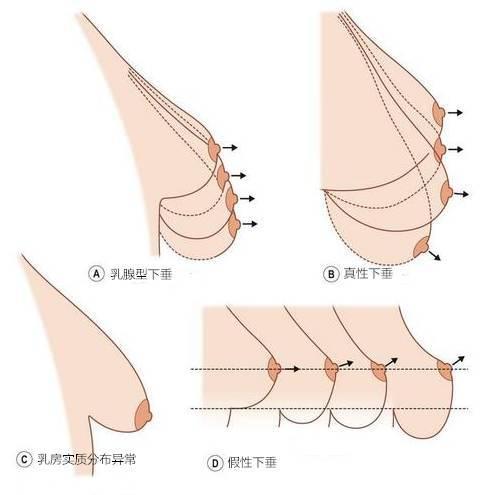 内衣选错了，乳腺癌、乳房下垂都找上门来了？