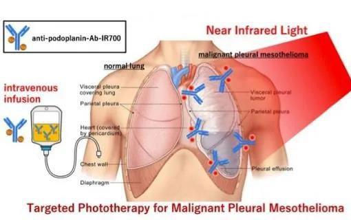 新疗法丨近红外光免疫疗法，有望治疗恶性胸膜间皮瘤