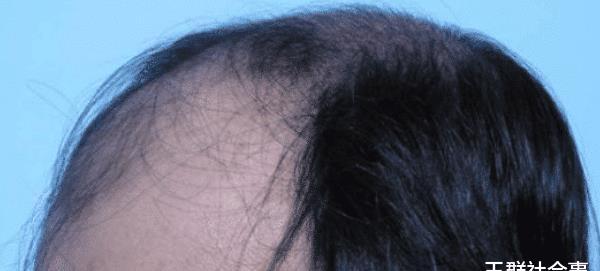 很多秃顶的人，宁愿周围留一圈头发，也不愿剃成光头？