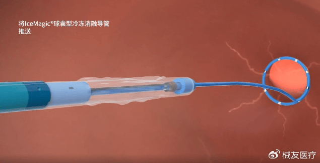 进口造影剂有哪些别吹进口了！中国这款冷冻消融系统杀进欧盟_https://www.jmylbn.com_新闻资讯_第1张